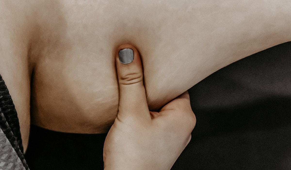 Treating Loose Skin After Weight Loss