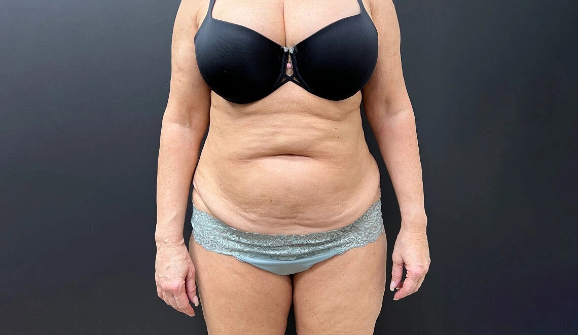 Tummy Tuck Before & After