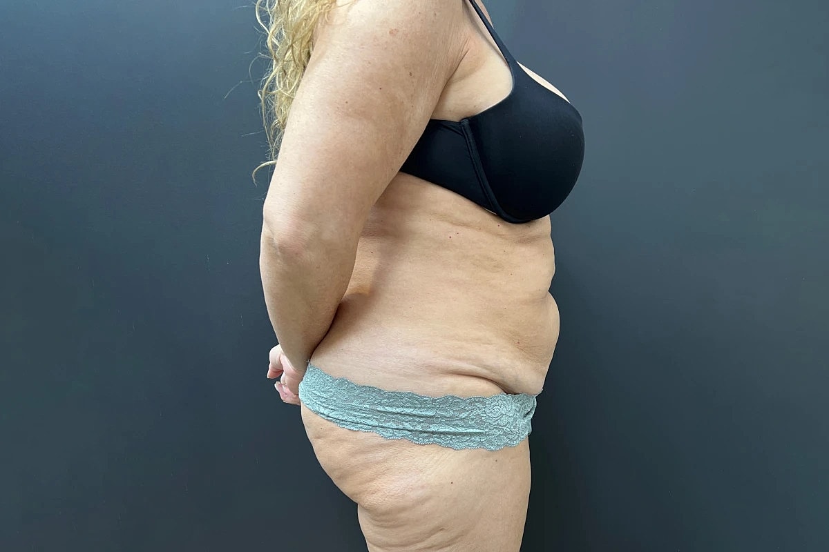 Tummy Tuck Before & After