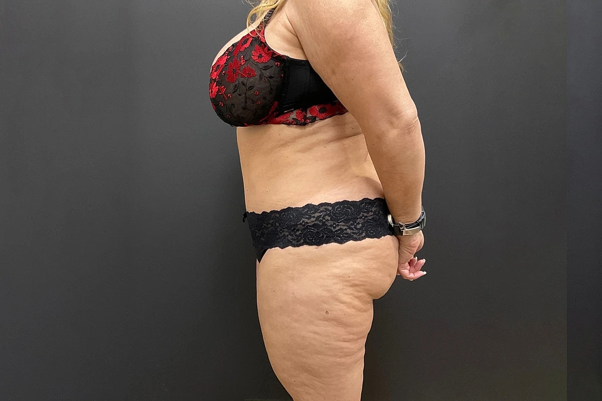 Tummy Tuck Before & After