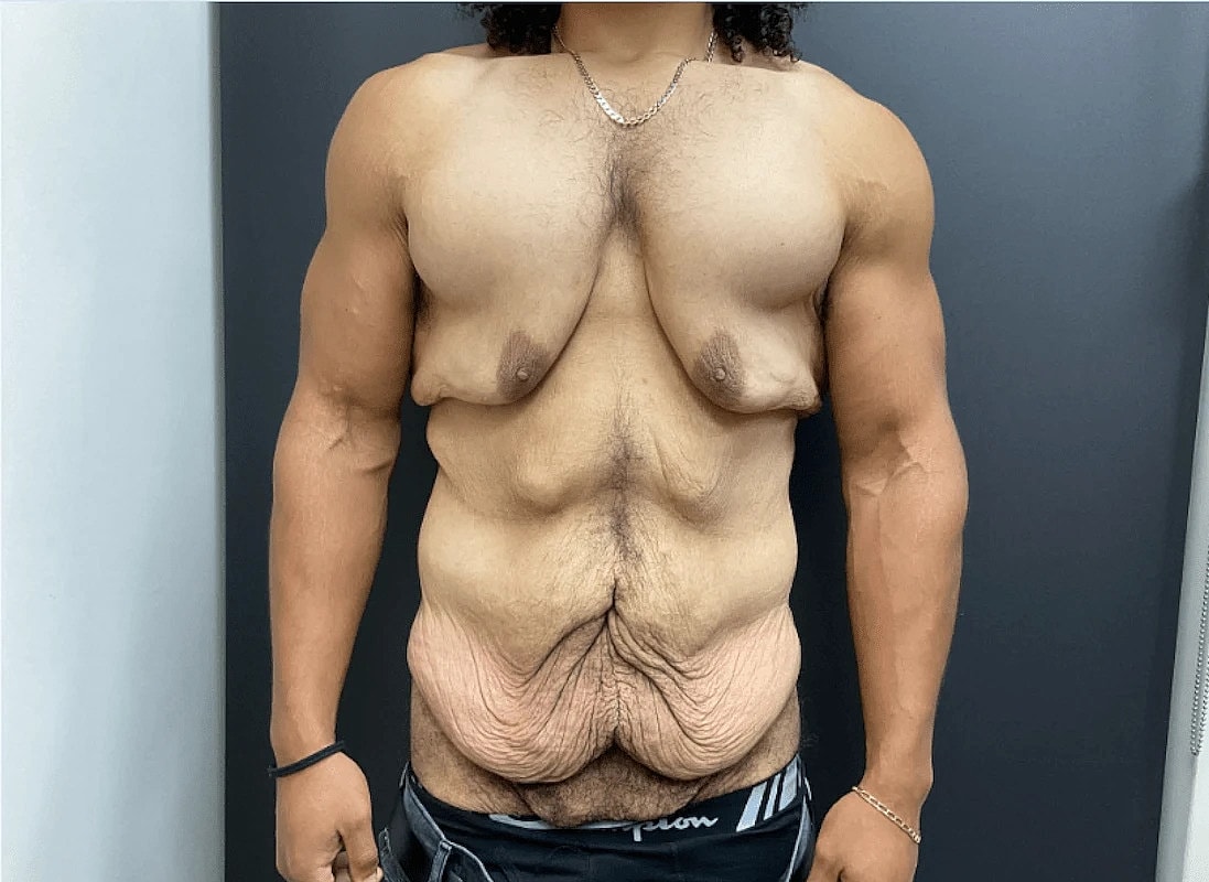 Tummy Tuck Before & After