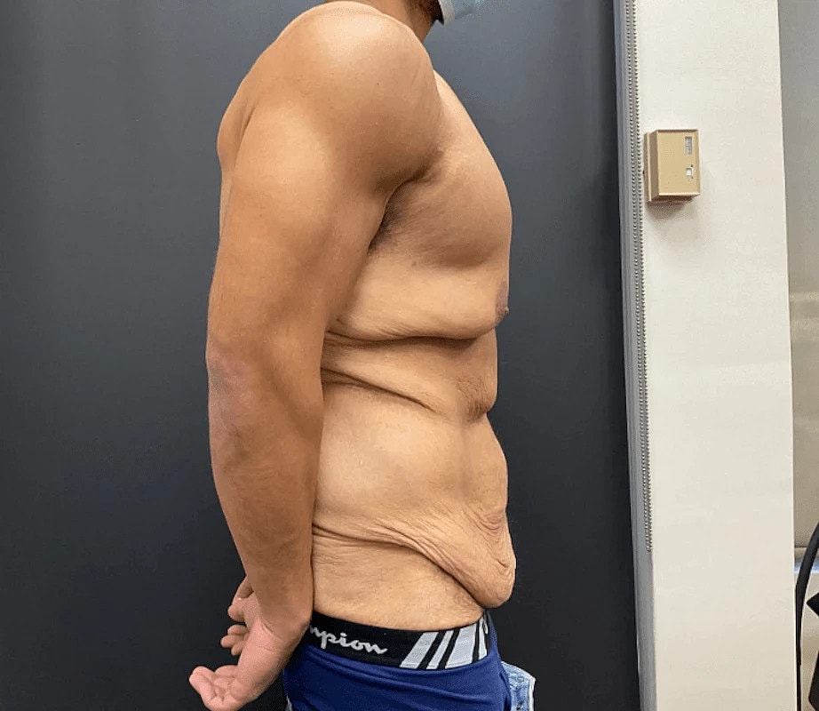 Tummy Tuck Before & After