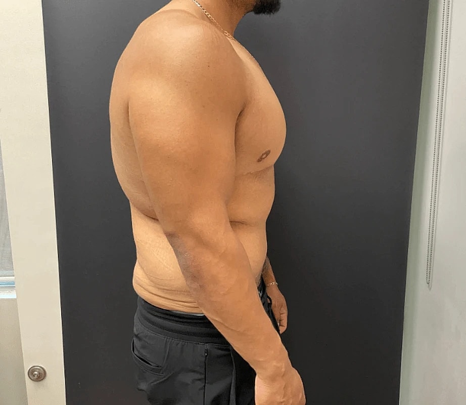 Tummy Tuck Before & After