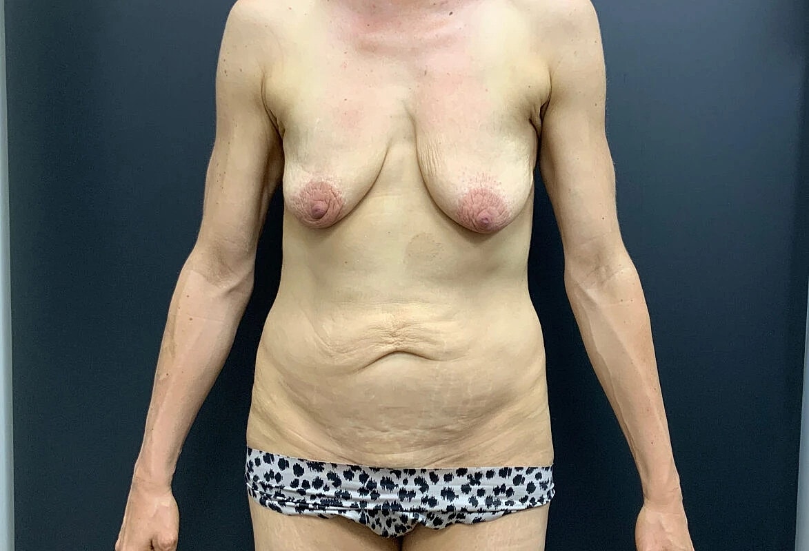 Tummy Tuck Before & After