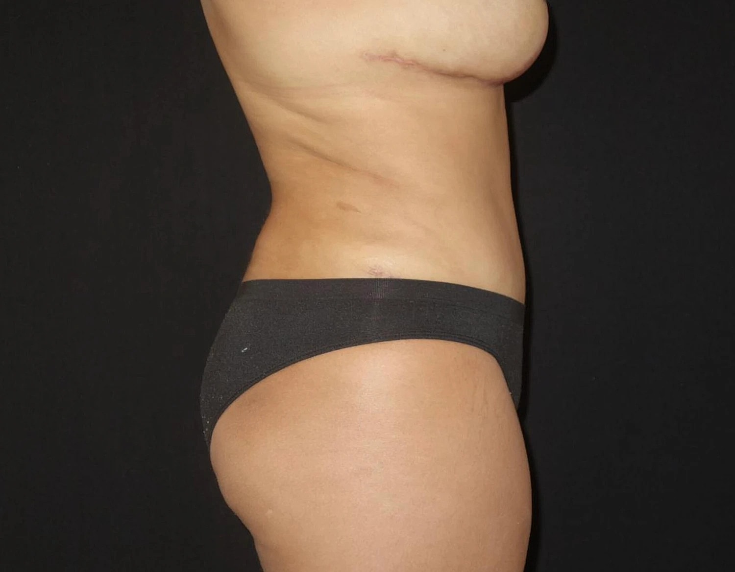 Tummy Tuck Before & After
