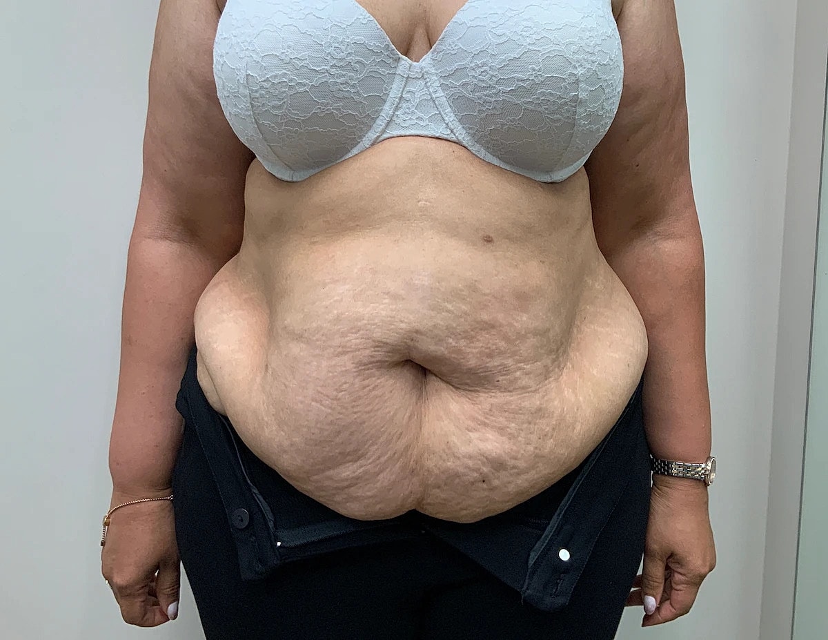 Tummy Tuck Before & After