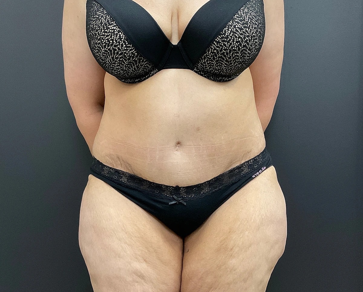 Tummy Tuck Before & After