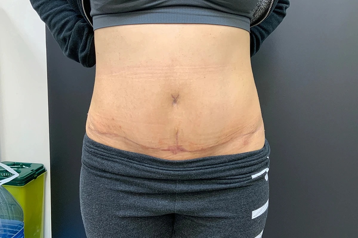 Tummy Tuck Before & After