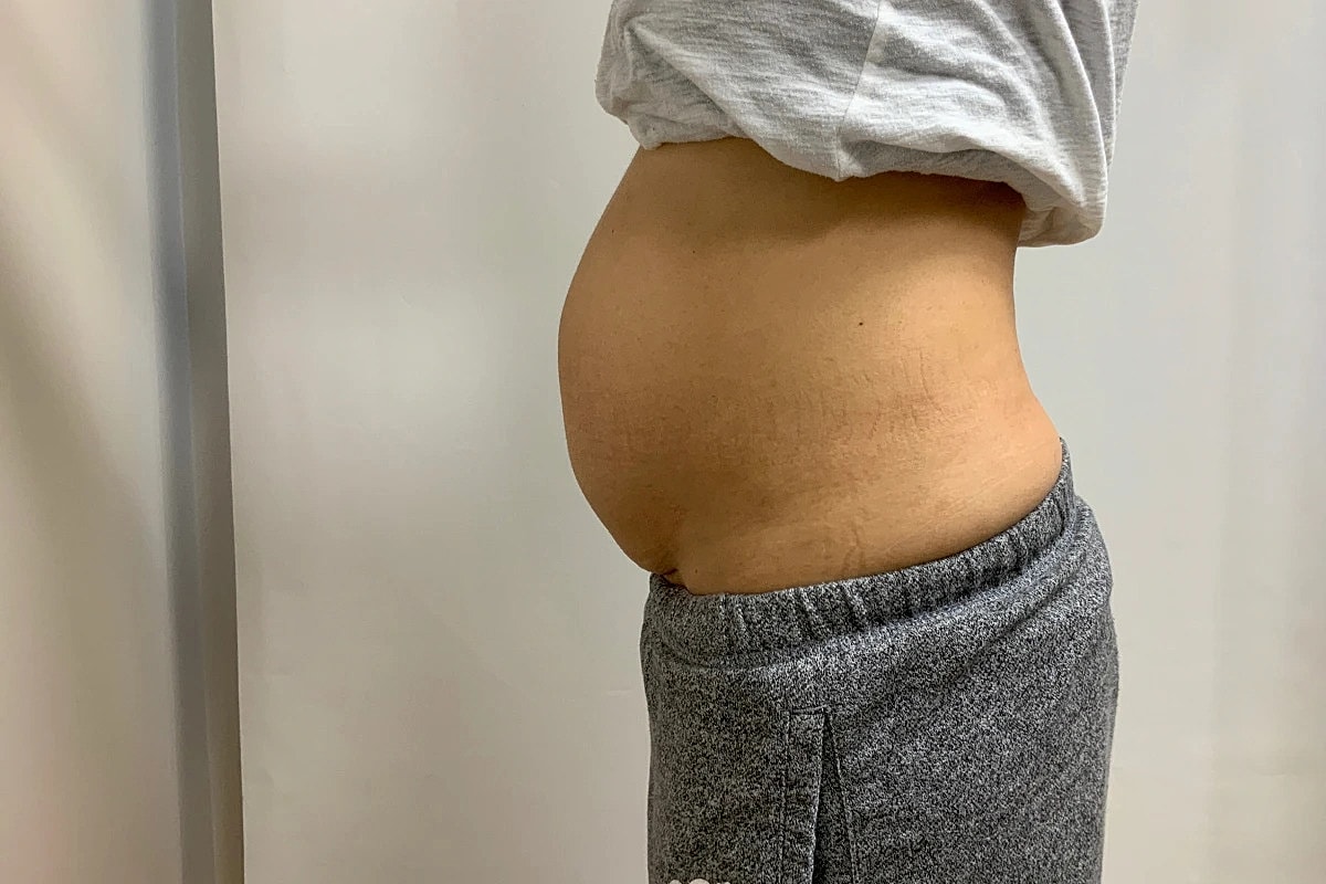 Tummy Tuck Before & After
