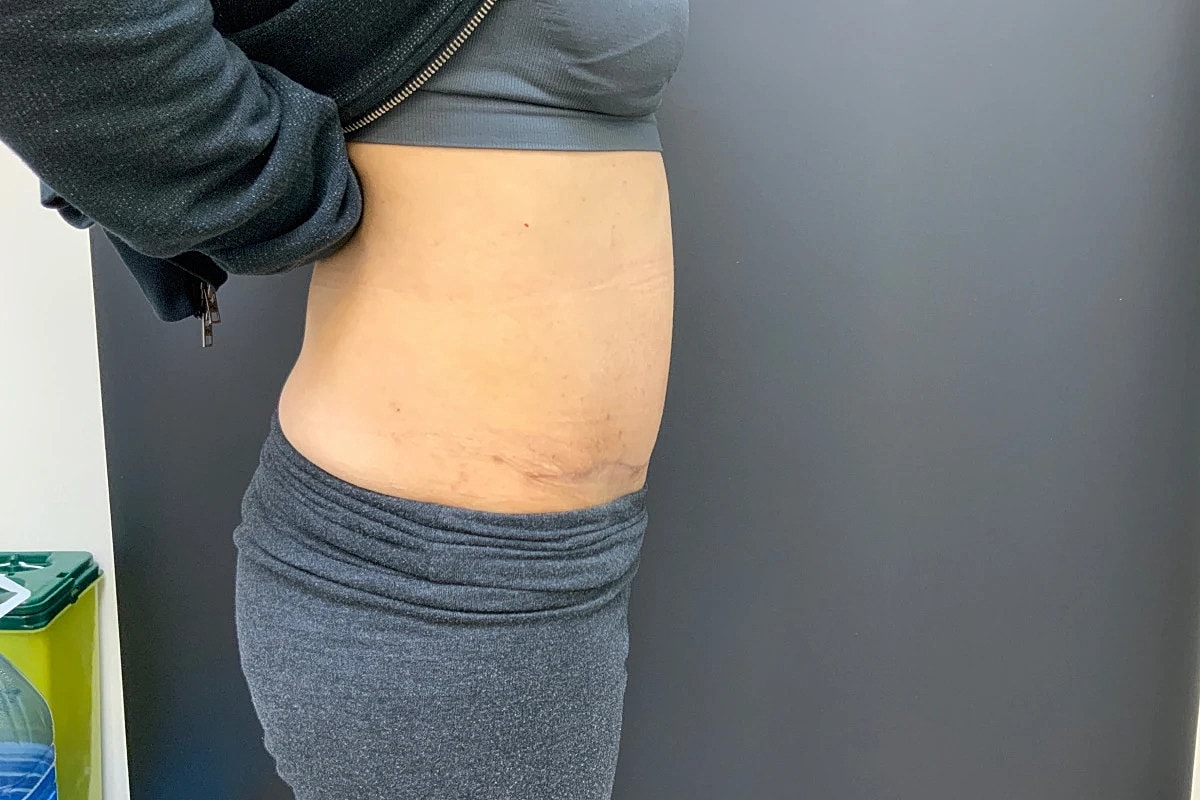 Tummy Tuck Before & After