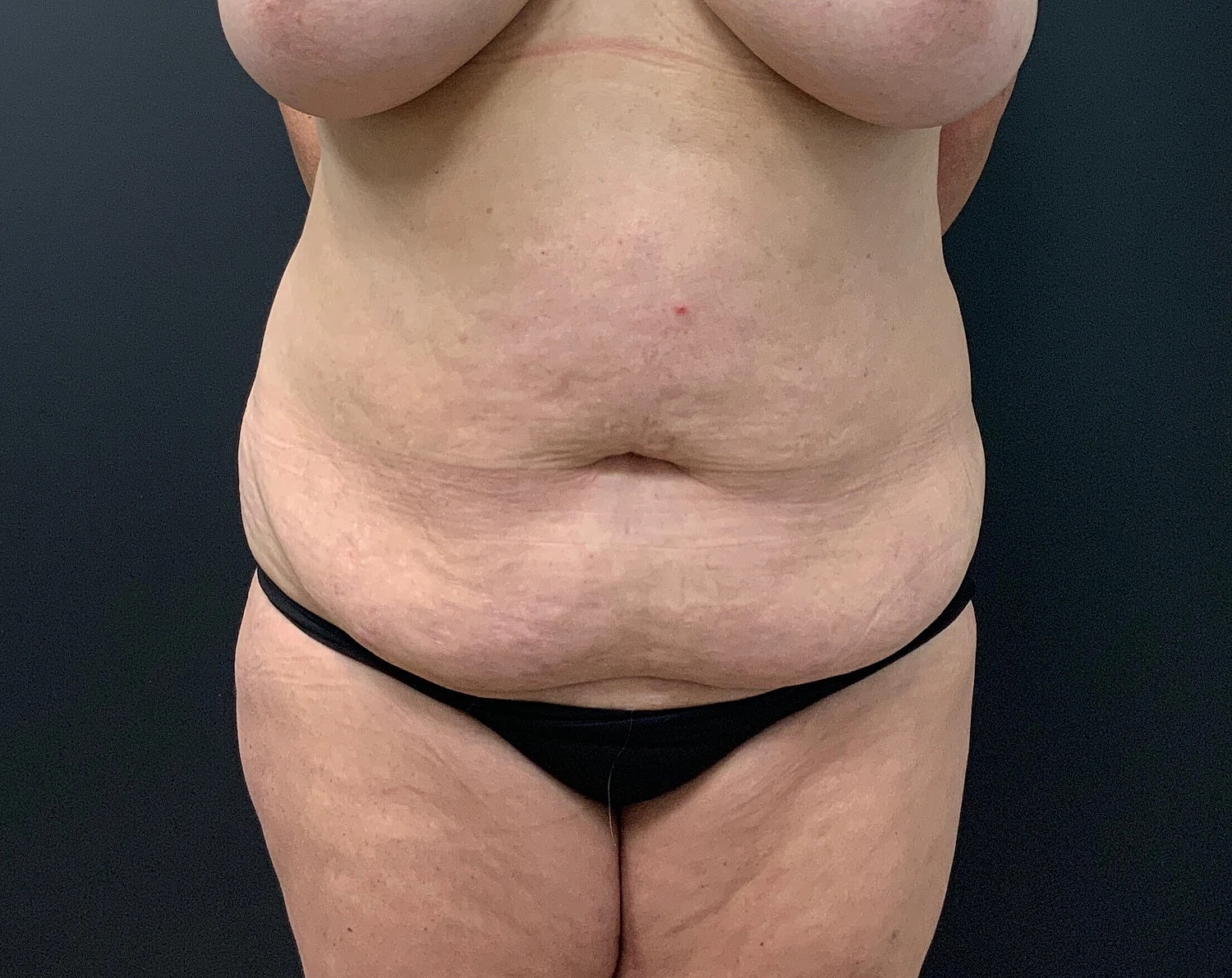 Tummy Tuck Before & After