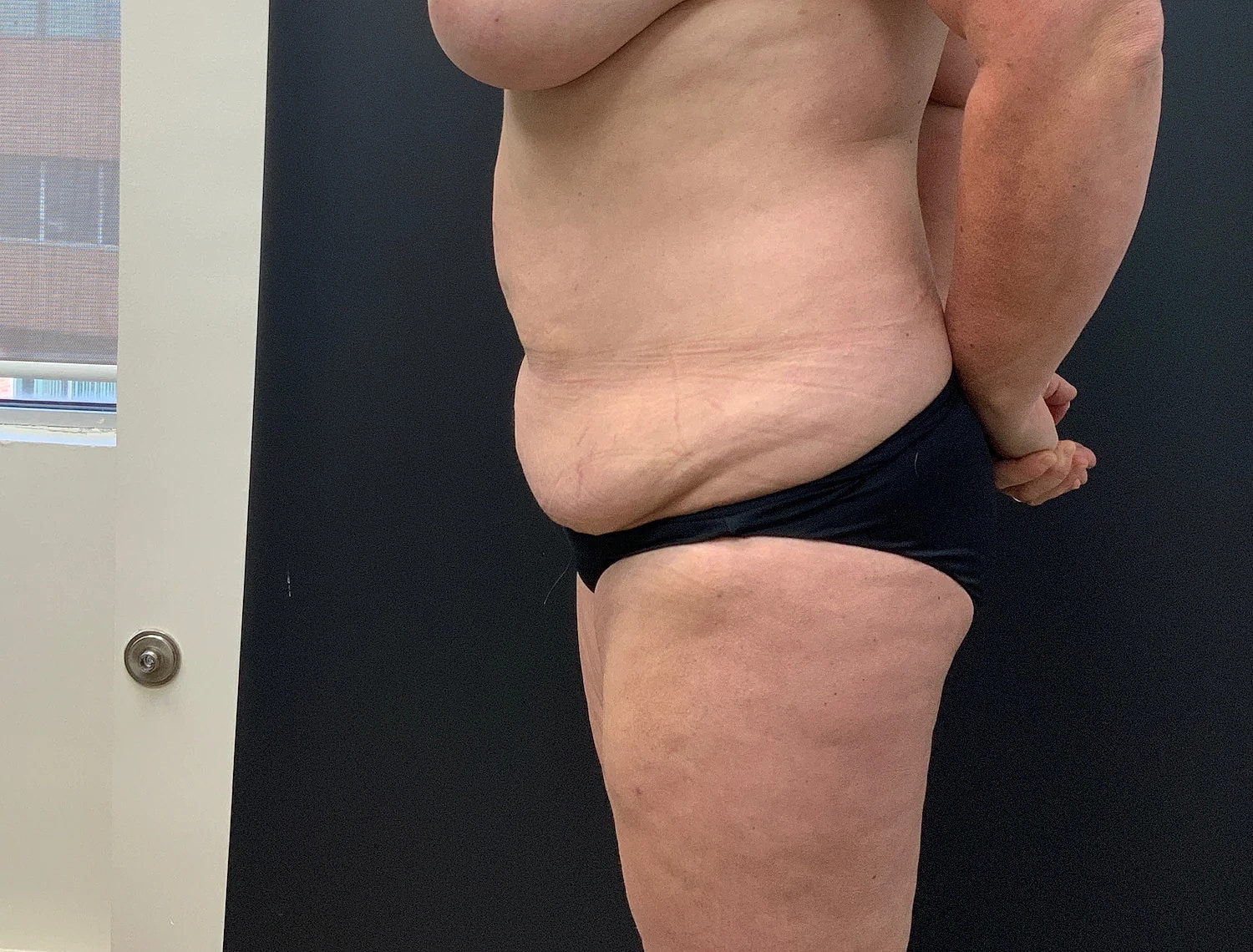 Tummy Tuck Before & After