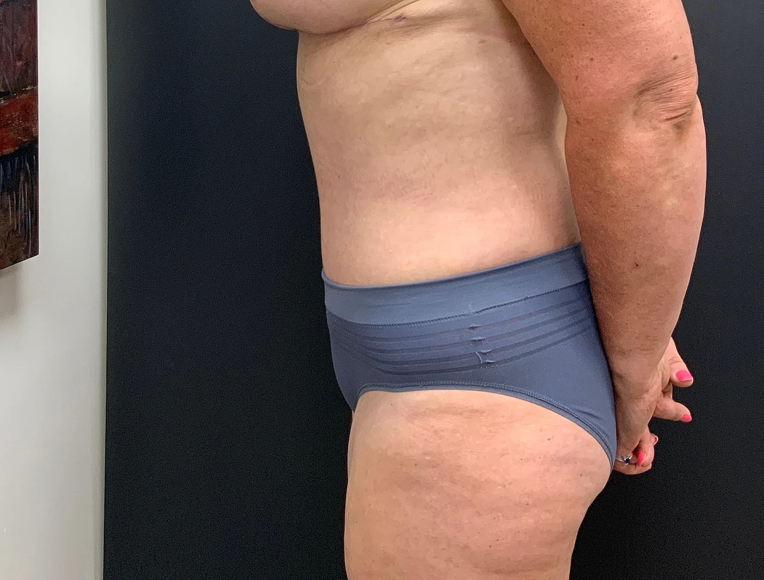 Tummy Tuck Before & After
