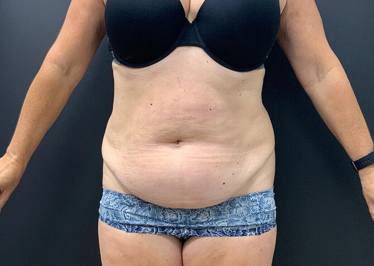 Tummy Tuck Before & After