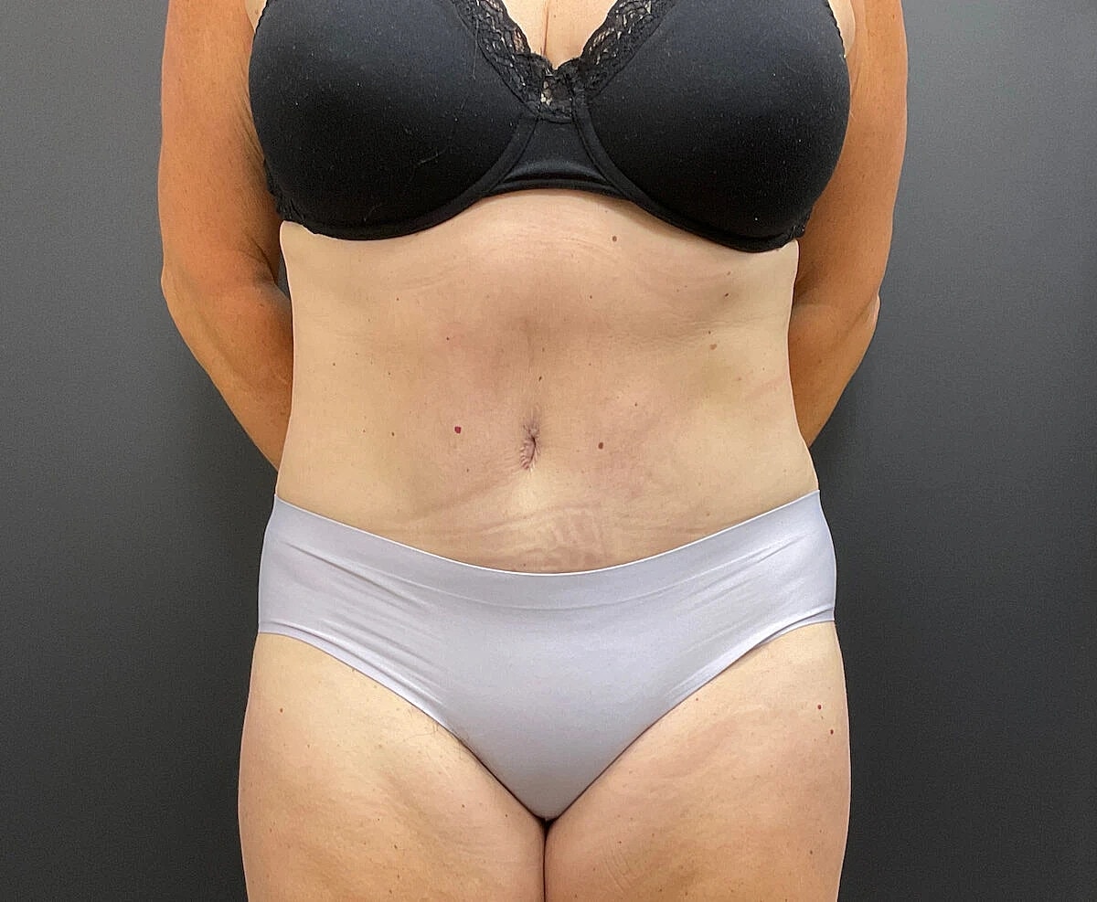 Tummy Tuck Before & After