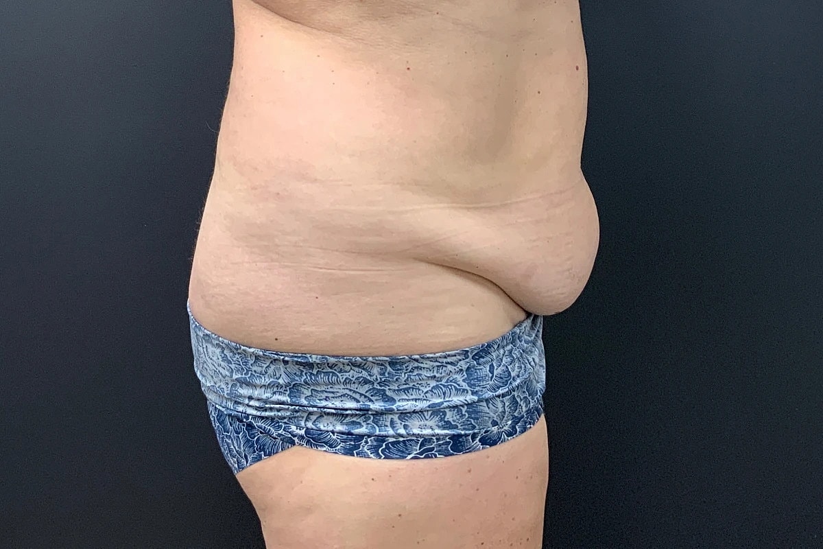 Tummy Tuck Before & After