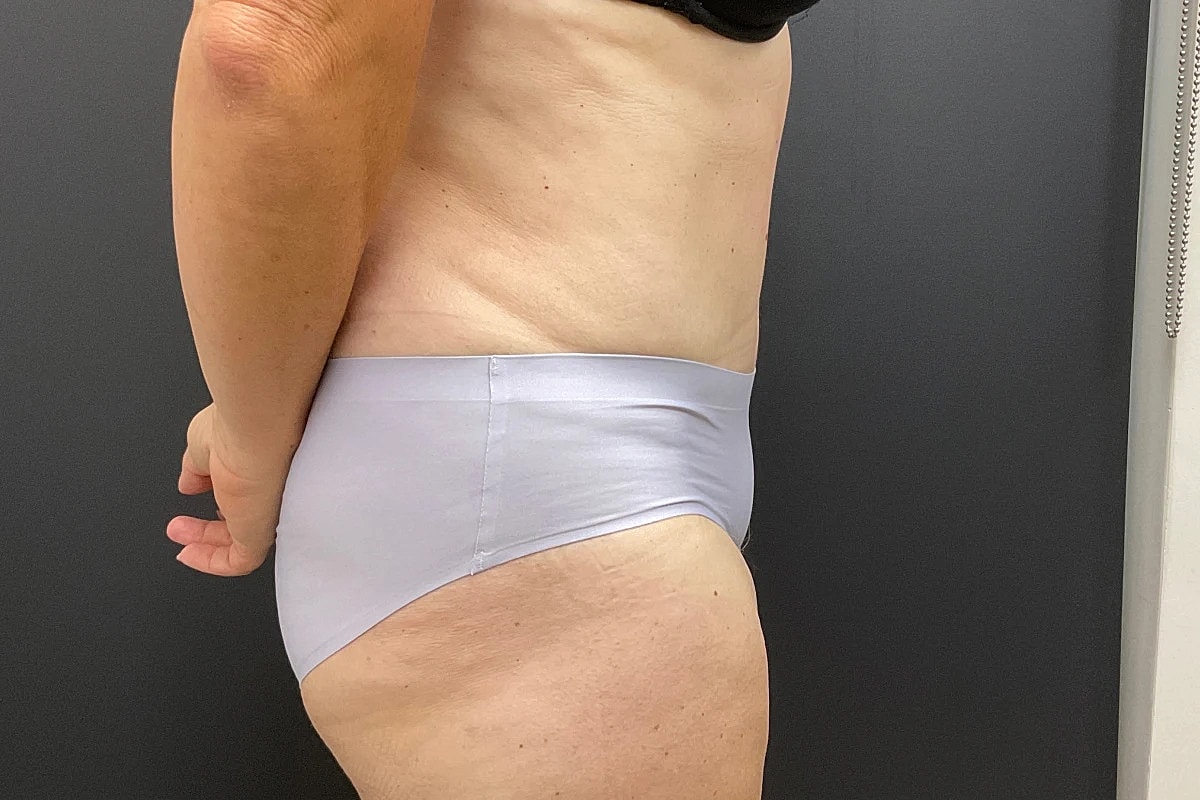 Tummy Tuck Before & After