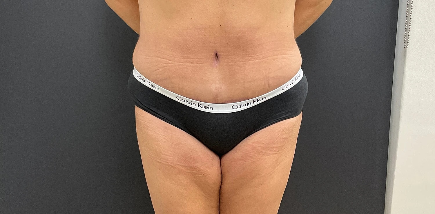 Tummy Tuck Before & After