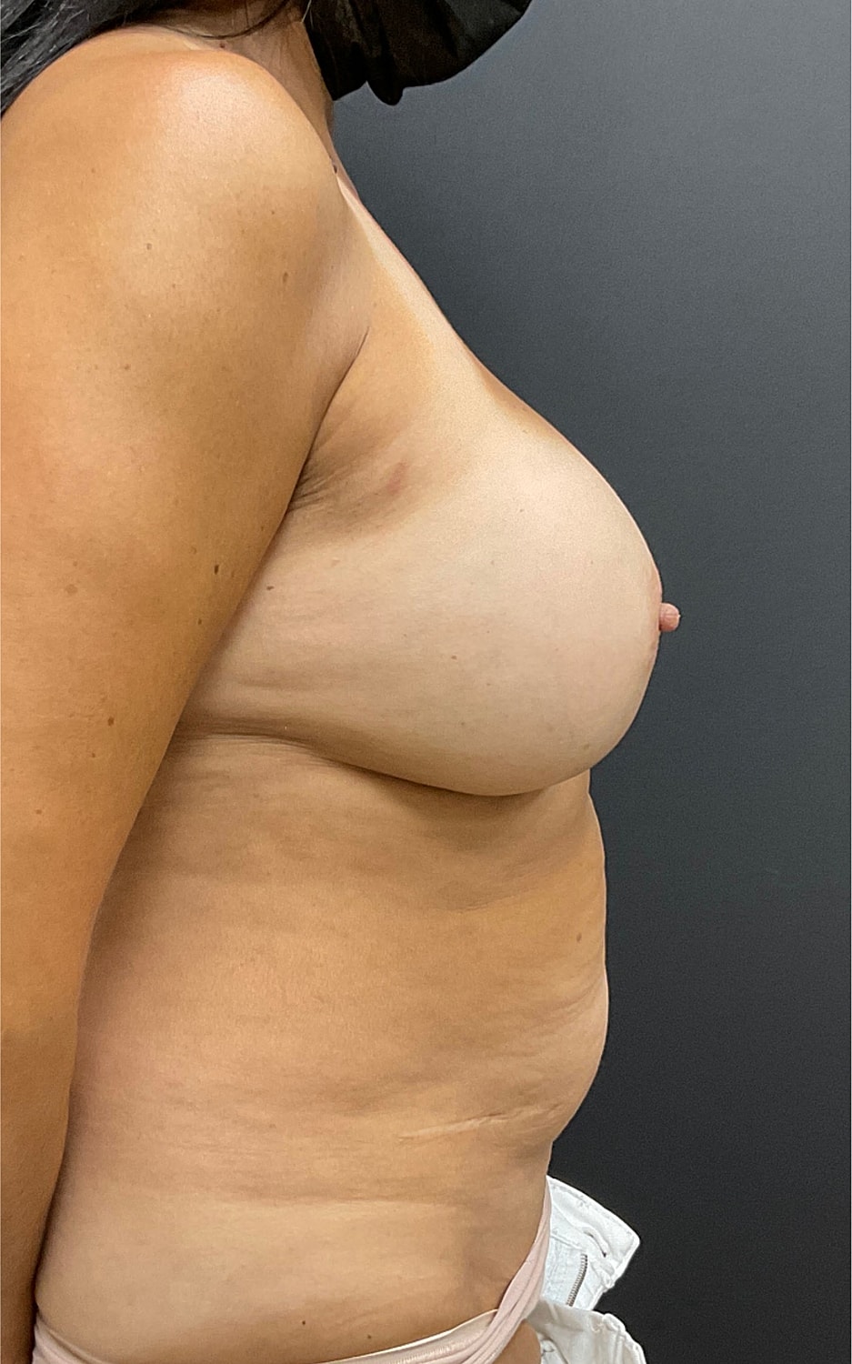 Tummy Tuck Before & After