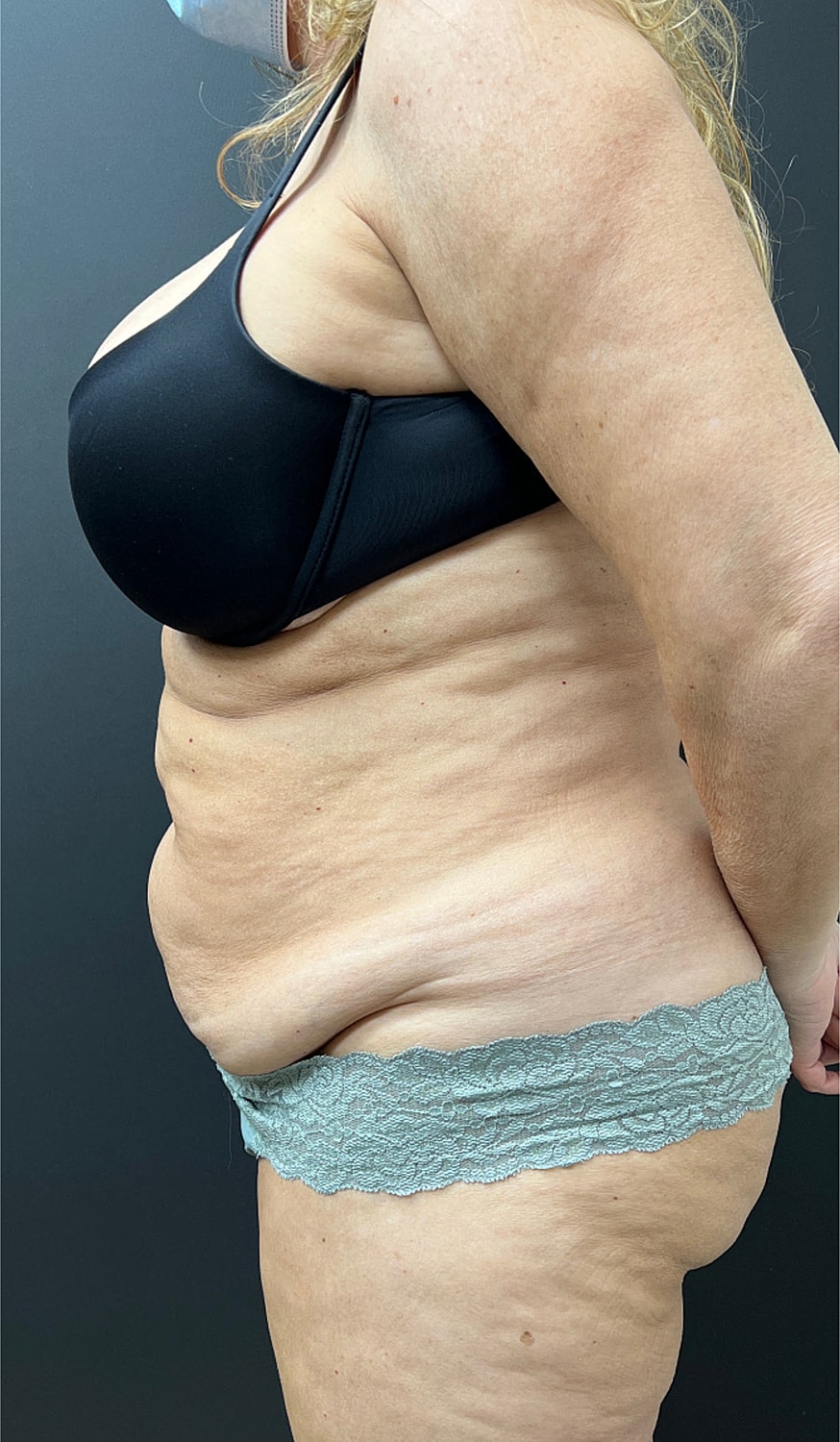 Tummy Tuck Before & After