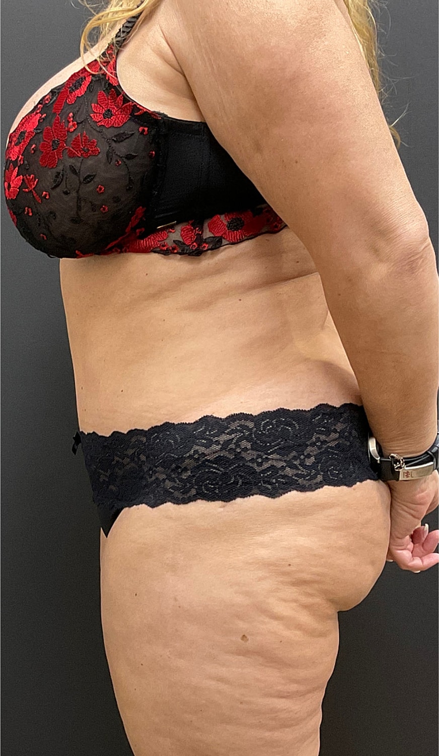 Tummy Tuck Before & After