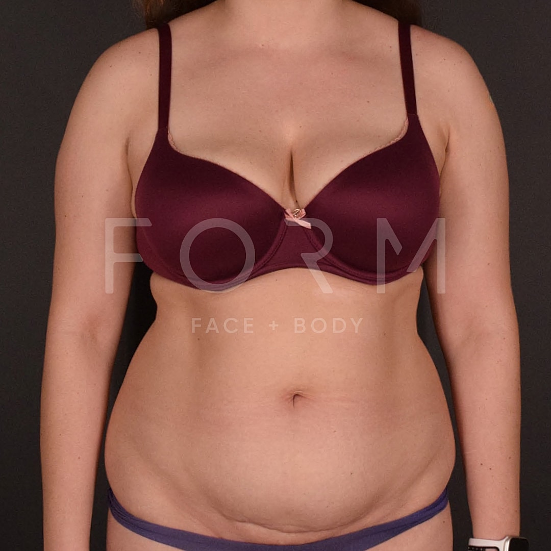 Tummy Tuck Before & After