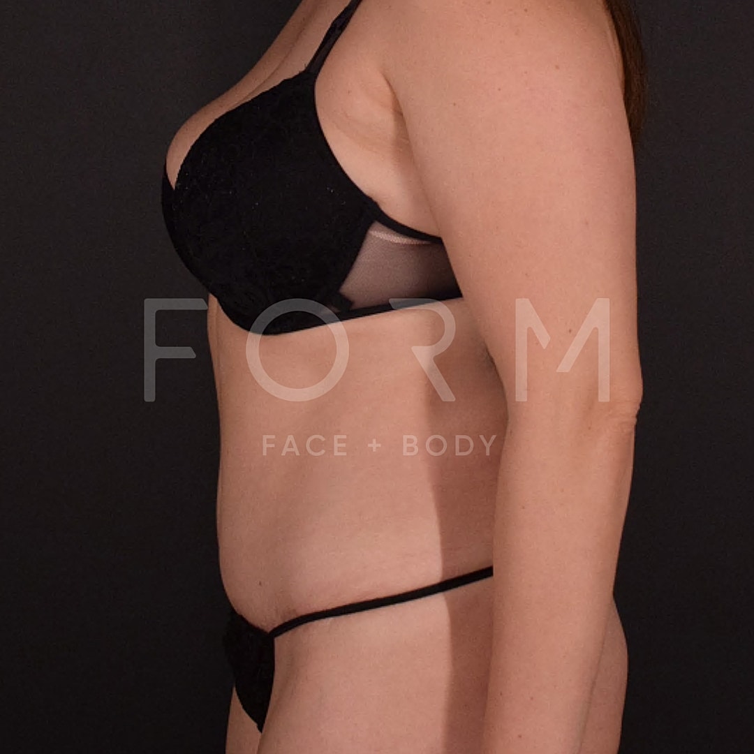 Tummy Tuck Before & After