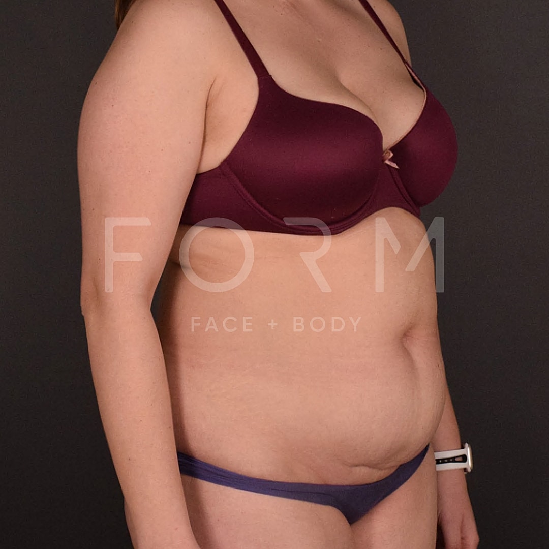 Tummy Tuck Before & After