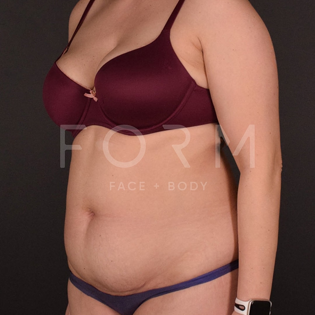 Tummy Tuck Before & After