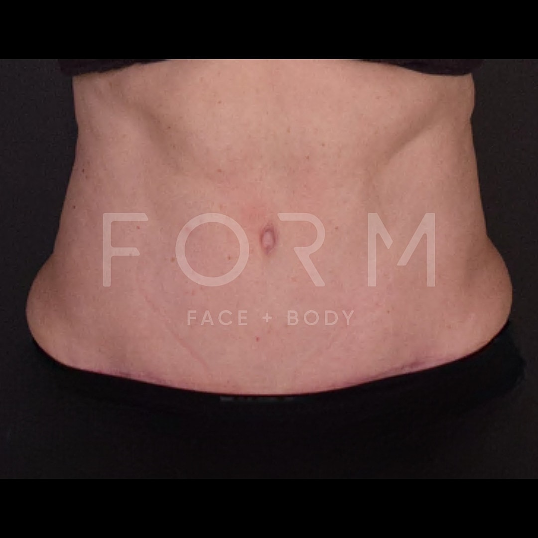 Tummy Tuck Before & After