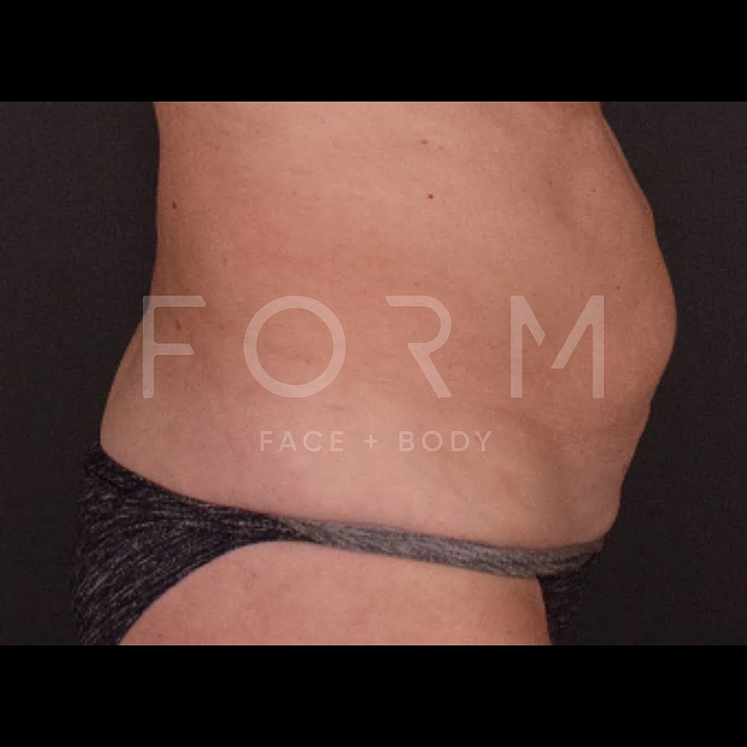 Tummy Tuck Before & After