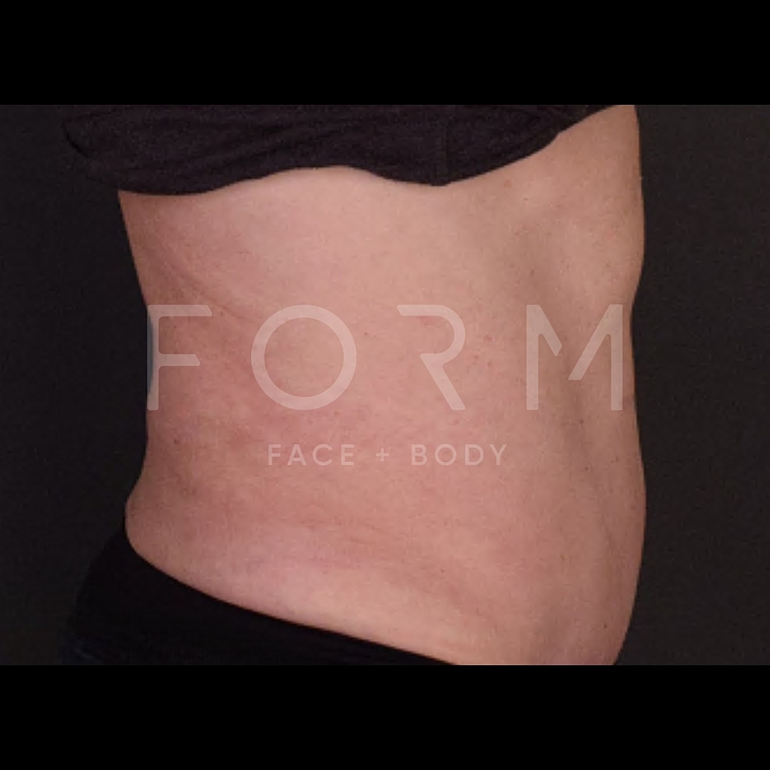 Tummy Tuck Before & After