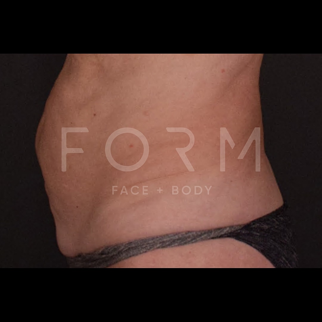 Tummy Tuck Before & After