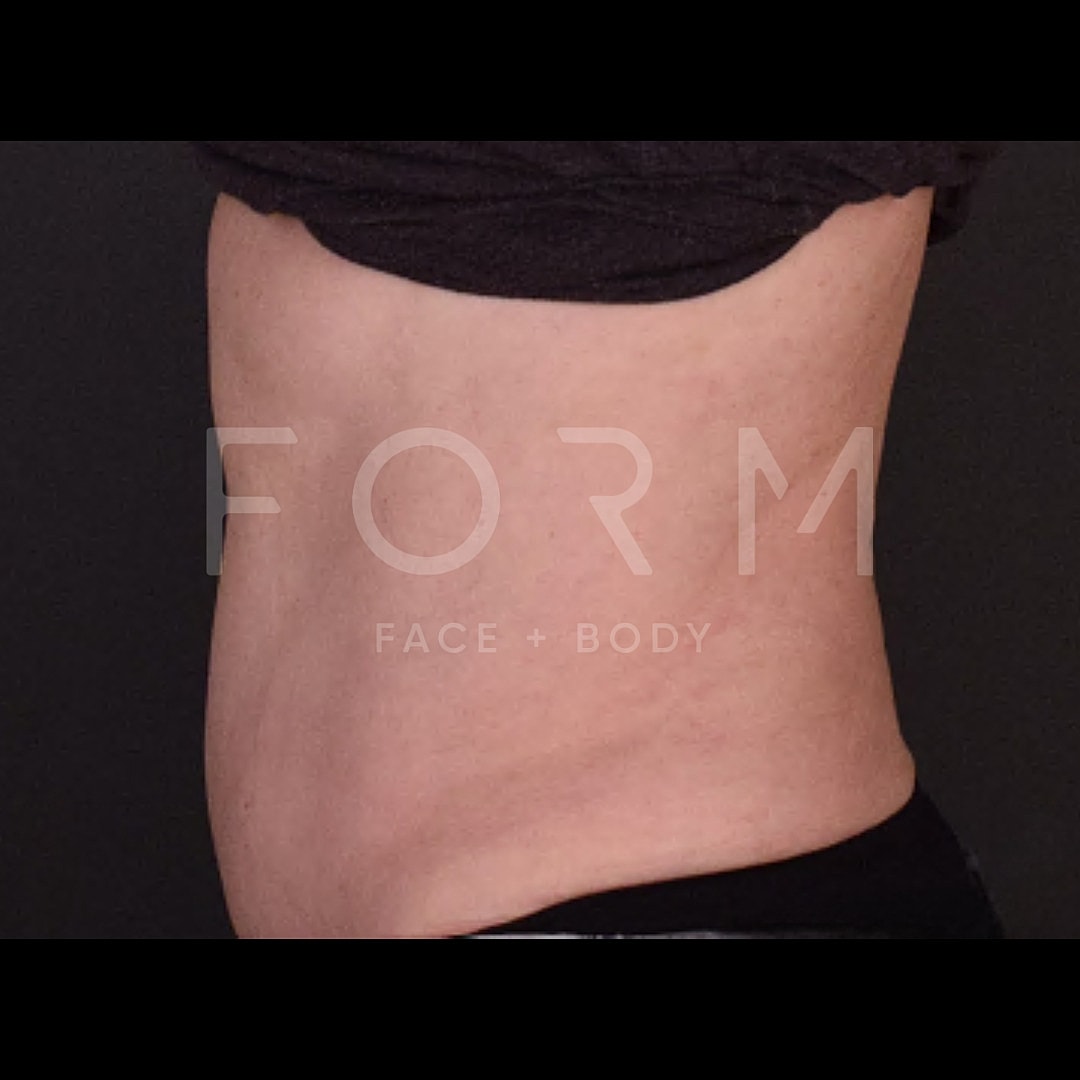 Tummy Tuck Before & After