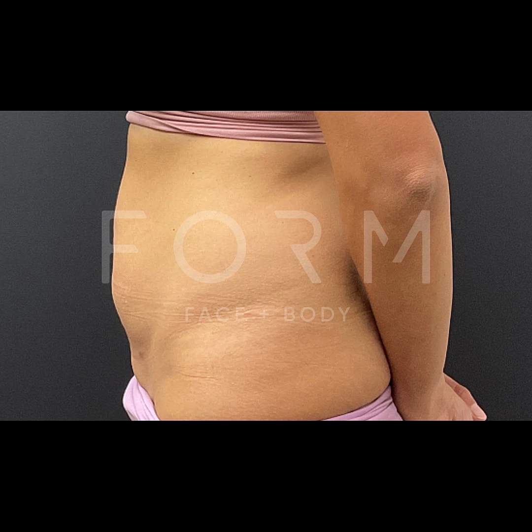 Tummy Tuck Before & After