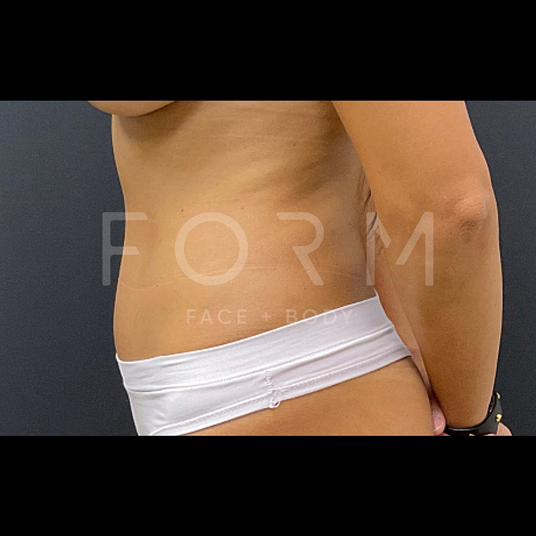 Tummy Tuck Before & After
