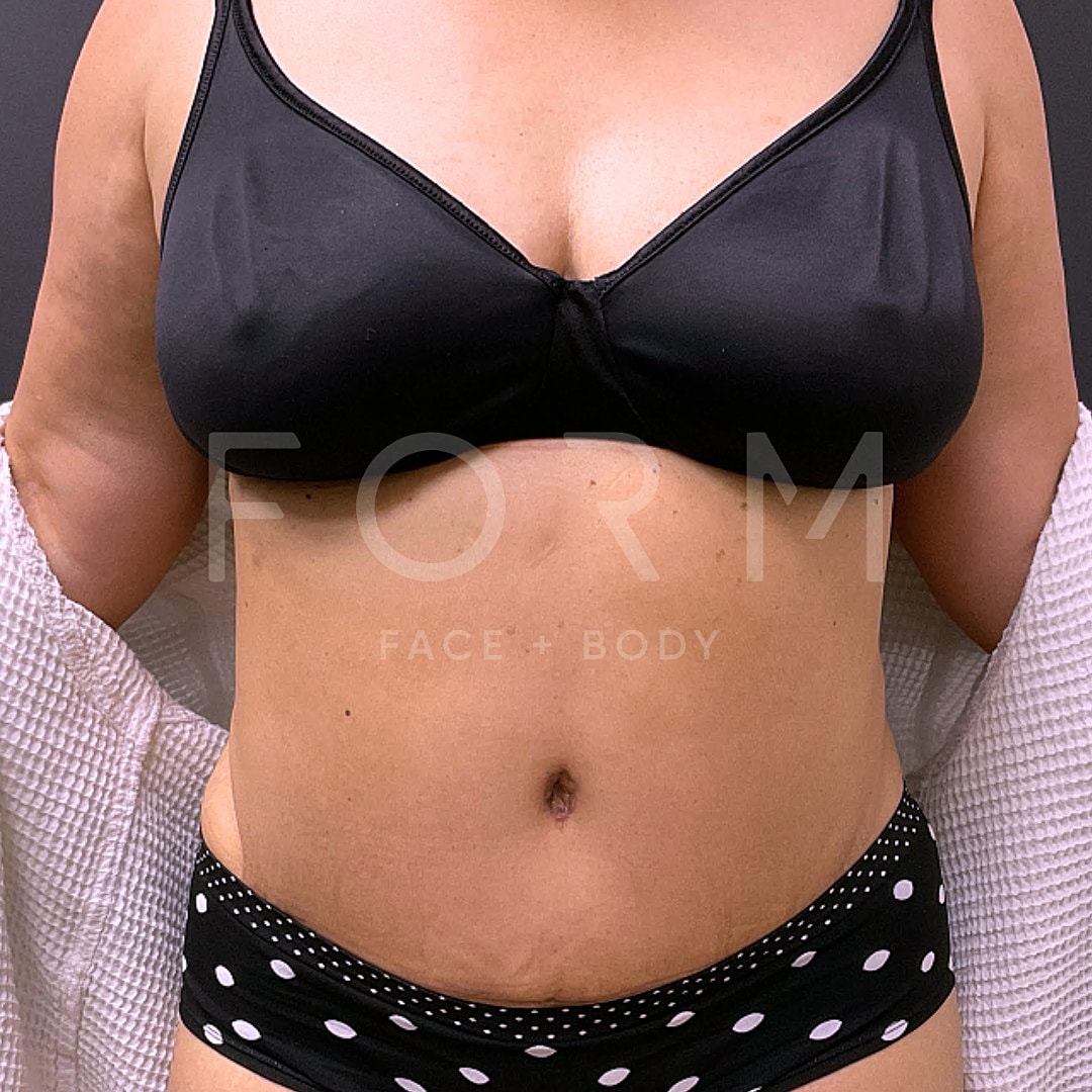 Tummy Tuck Before & After