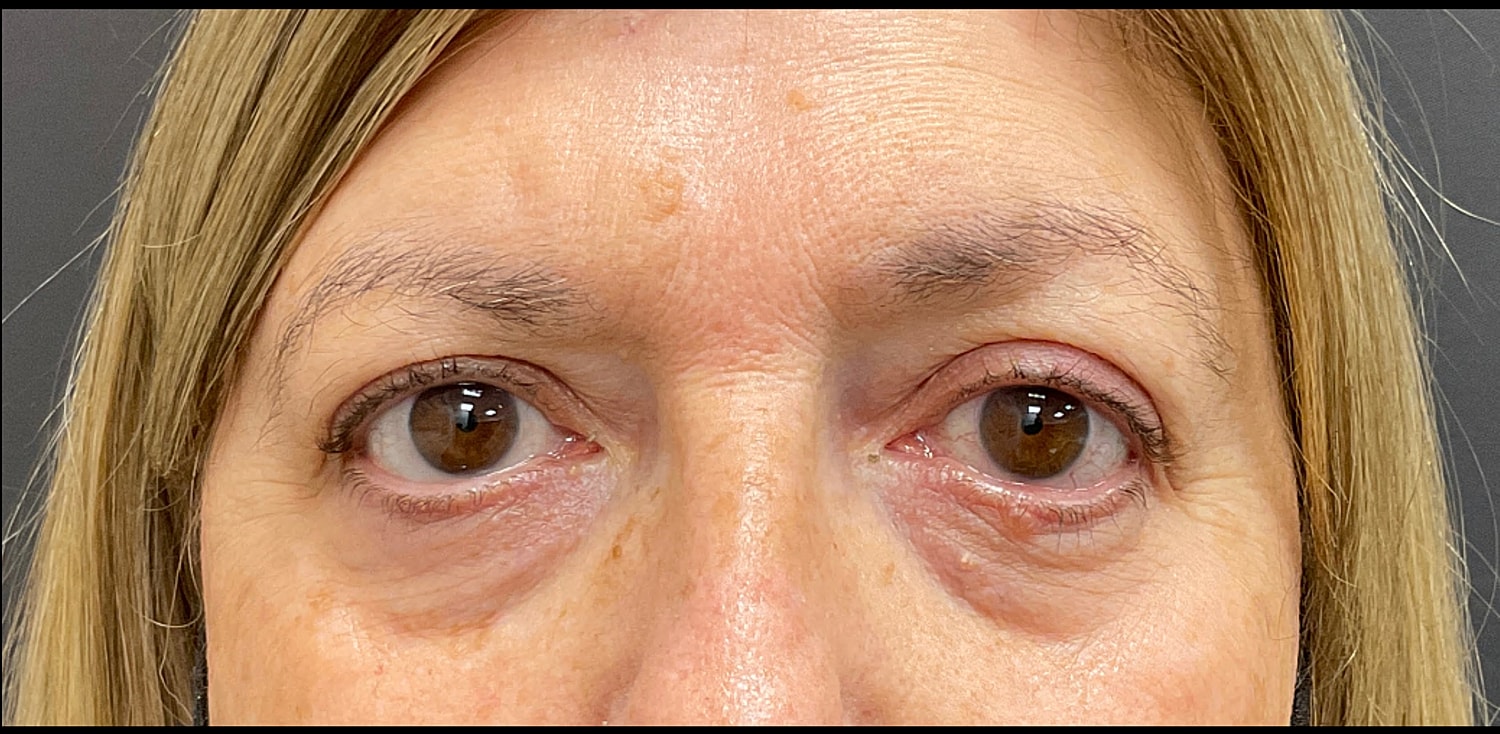 Blepharoplasty Eyelid Surgery Before & After