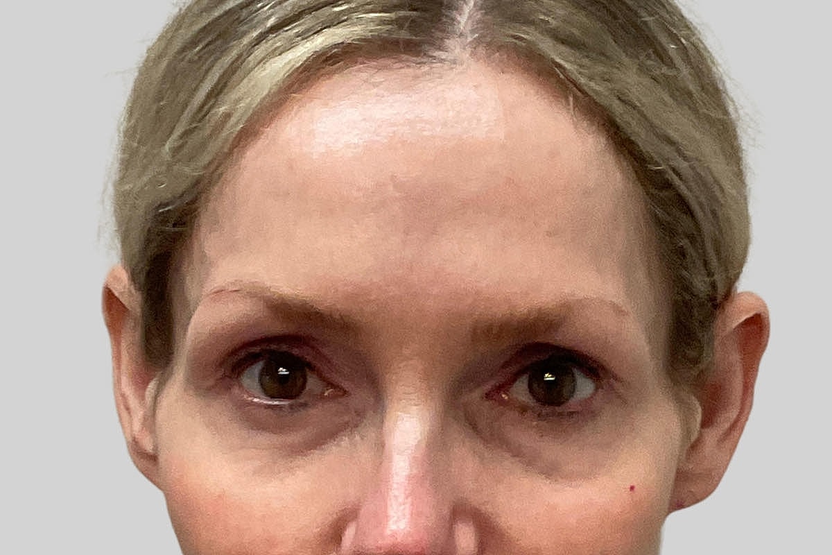 Blepharoplasty Eyelid Surgery Before & After