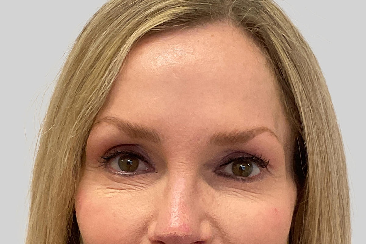 Blepharoplasty Eyelid Surgery Before & After