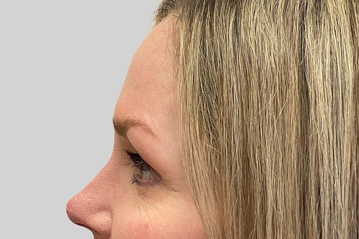 Blepharoplasty Eyelid Surgery Before & After