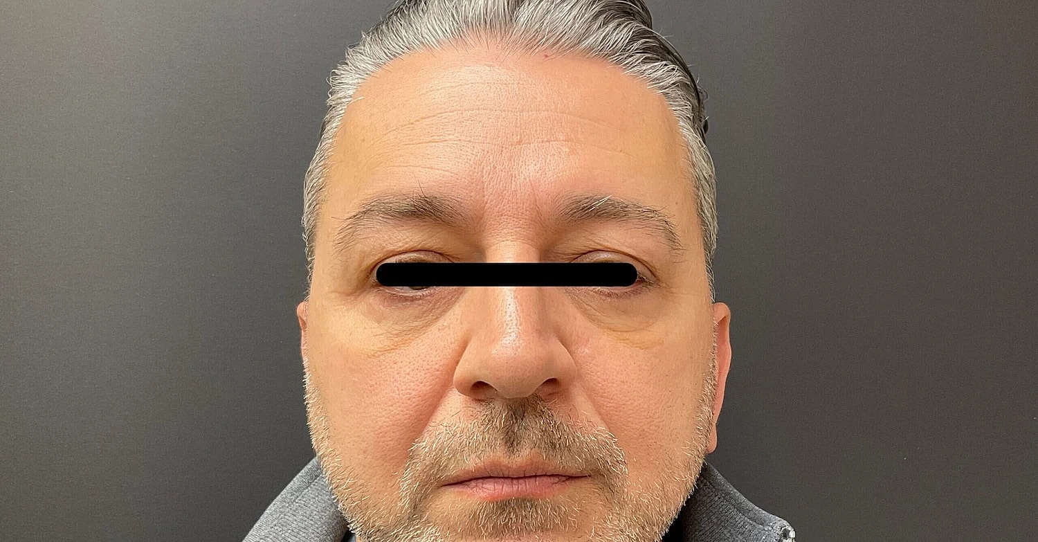 Blepharoplasty Eyelid Surgery Before & After