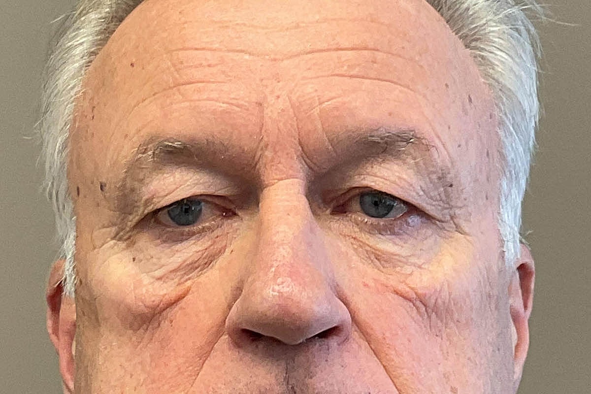 Blepharoplasty Eyelid Surgery Before & After