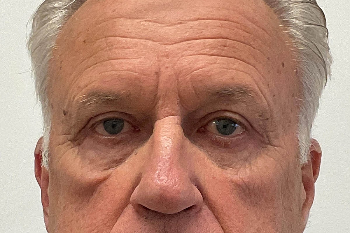 Blepharoplasty Eyelid Surgery Before & After