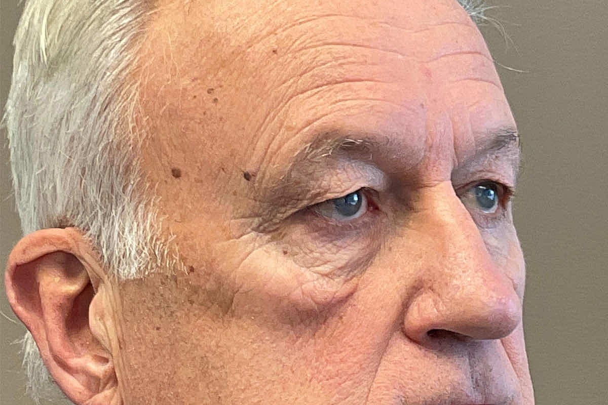 Blepharoplasty Eyelid Surgery Before & After