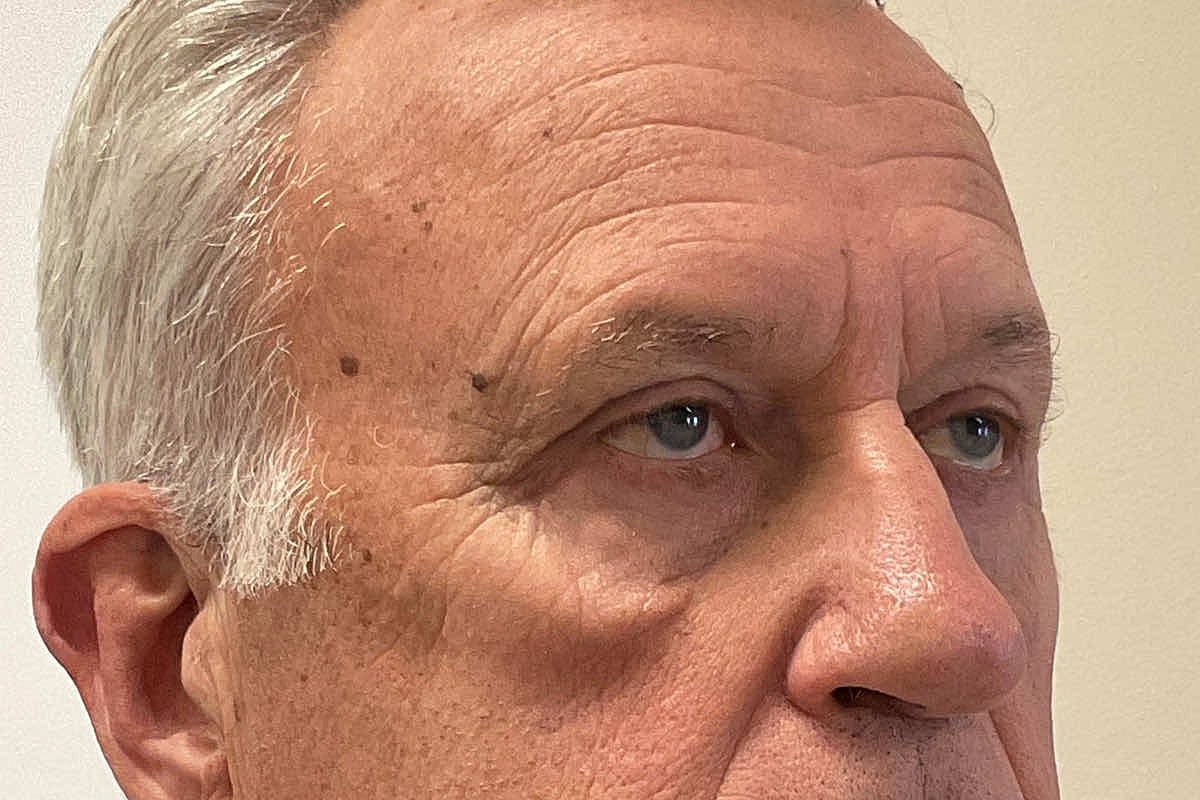 Blepharoplasty Eyelid Surgery Before & After