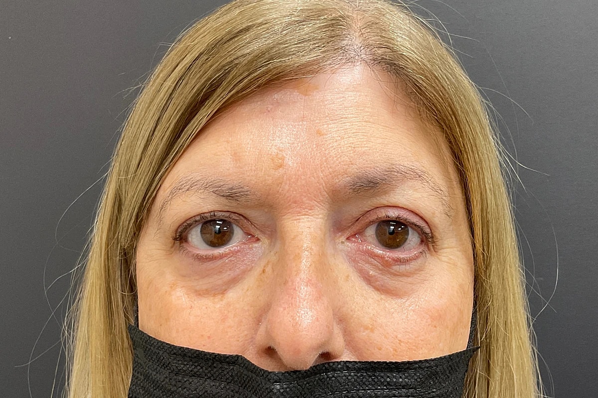 Blepharoplasty Eyelid Surgery Before & After