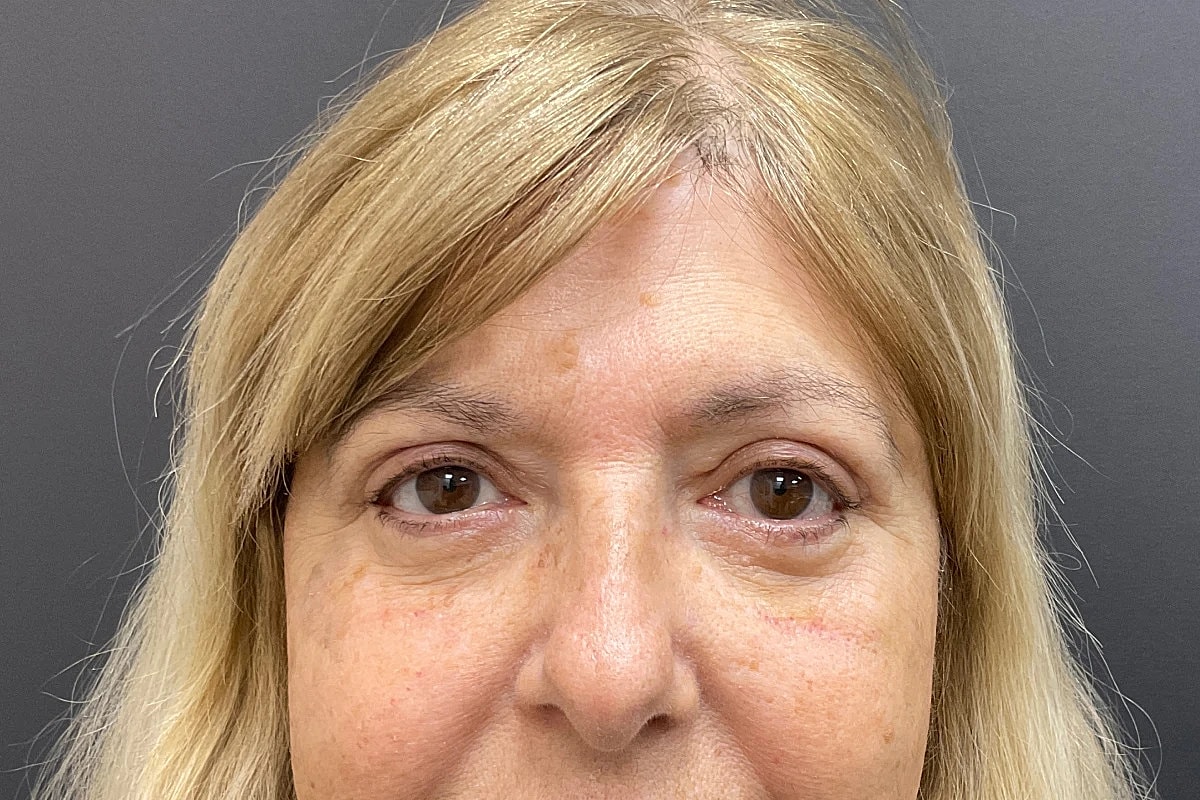 Blepharoplasty Eyelid Surgery Before & After