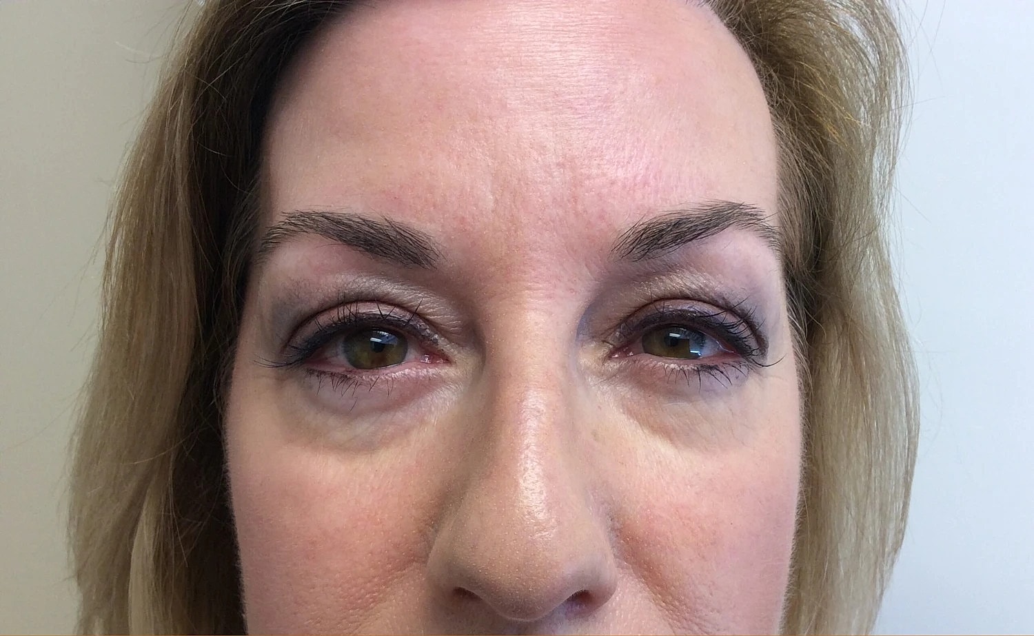 Blepharoplasty Eyelid Surgery Before & After