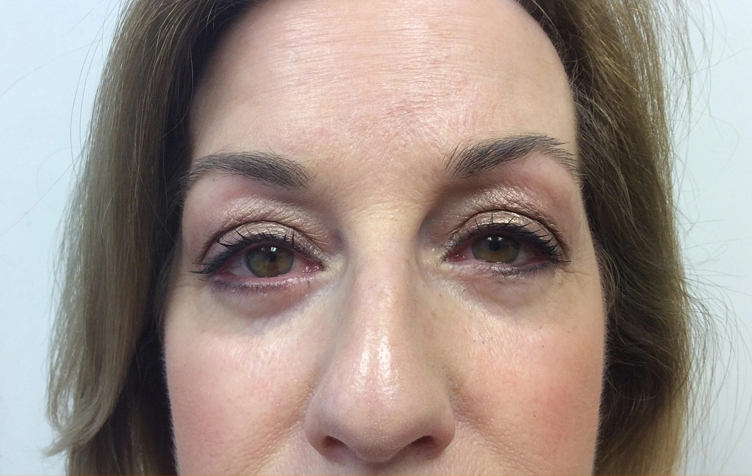 Blepharoplasty Eyelid Surgery Before & After